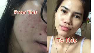 ACNE FIGHTER/ PEJUANG JERAWAT BANDEL