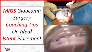 MIGS Glaucoma Surgery - Coaching Tips on Ideal iStent Placement