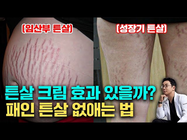 성장기 튼살, 튼살 없애는 방법과 관리 예방법, 튼살 치료 시기(피부과 전문의 오가나)