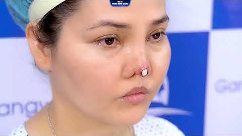 HÀNH TRÌNH TÌM LẠI DÁNG MŨI HOÀN THIỆN SAU 2 NĂM CÙNG VỚI BÁC SĨ PHÙNG MẠNH CƯỜNG