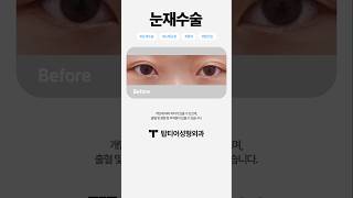 처음보다 예쁘게, 눈재수술 잘 하는 곳을 찾는다면?