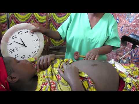 剛果民主共和國的產科護理　Obstetric care in DRC