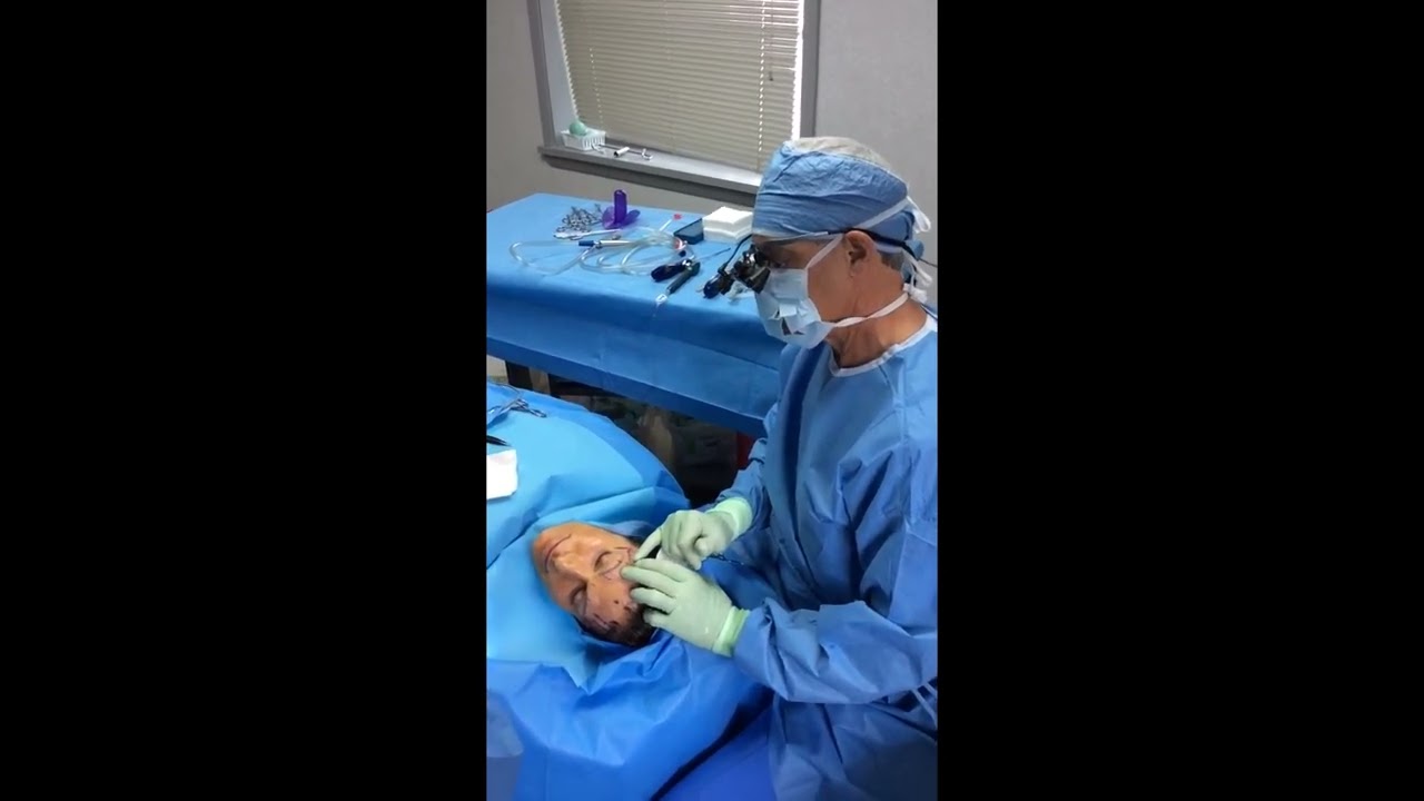 Lateral Subcutaneous Temporal Brow Lift in Milford, PA with Dr. Richard Buckley