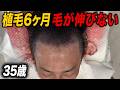 【30代薄毛】完成形まであと6ヶ月、本当に毛は生える!?