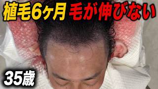 【30代薄毛】完成形まであと6ヶ月、本当に毛は生える!?