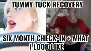 TUMMY TUCK SERIES: EPISODE 4 - 6 MONTH POST-OP CHECK-IN + WHAT I LOOK LIKE CURRENTLY