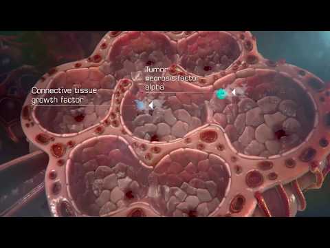 Idiopathic Pulmonary Fibrosis (IPF) Pathogenesis [HD]