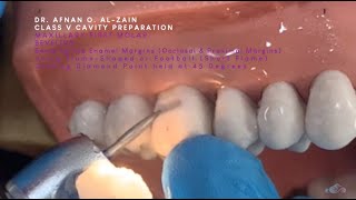 Class V cavity preparation for composite on a maxillary molar (#16) - Arabic عربي