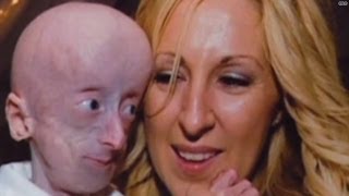 Rapidly aging boy may have new hope
