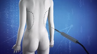 Why Brazilian butt lifts are so deadly Why Brazilian butt lifts are so deadly