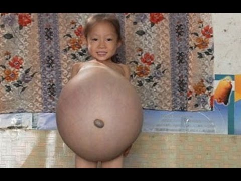 4 Year Old Girl Looks 9 Months Pregnant- Hu Yunxing