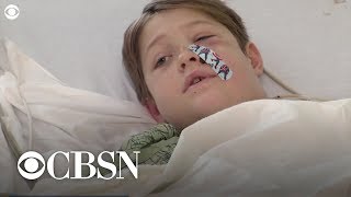 Boy impaled in the face with skewer is miraculously saved