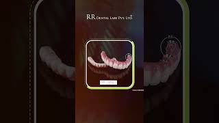 RR Dental Labs India’s Digital Leaders in Fire & Forget Implants & I-Dent Aligners