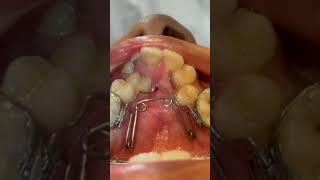 How to treat cleft lip and cleft palate cases? Orthodontics treatment for arch expansion with quad