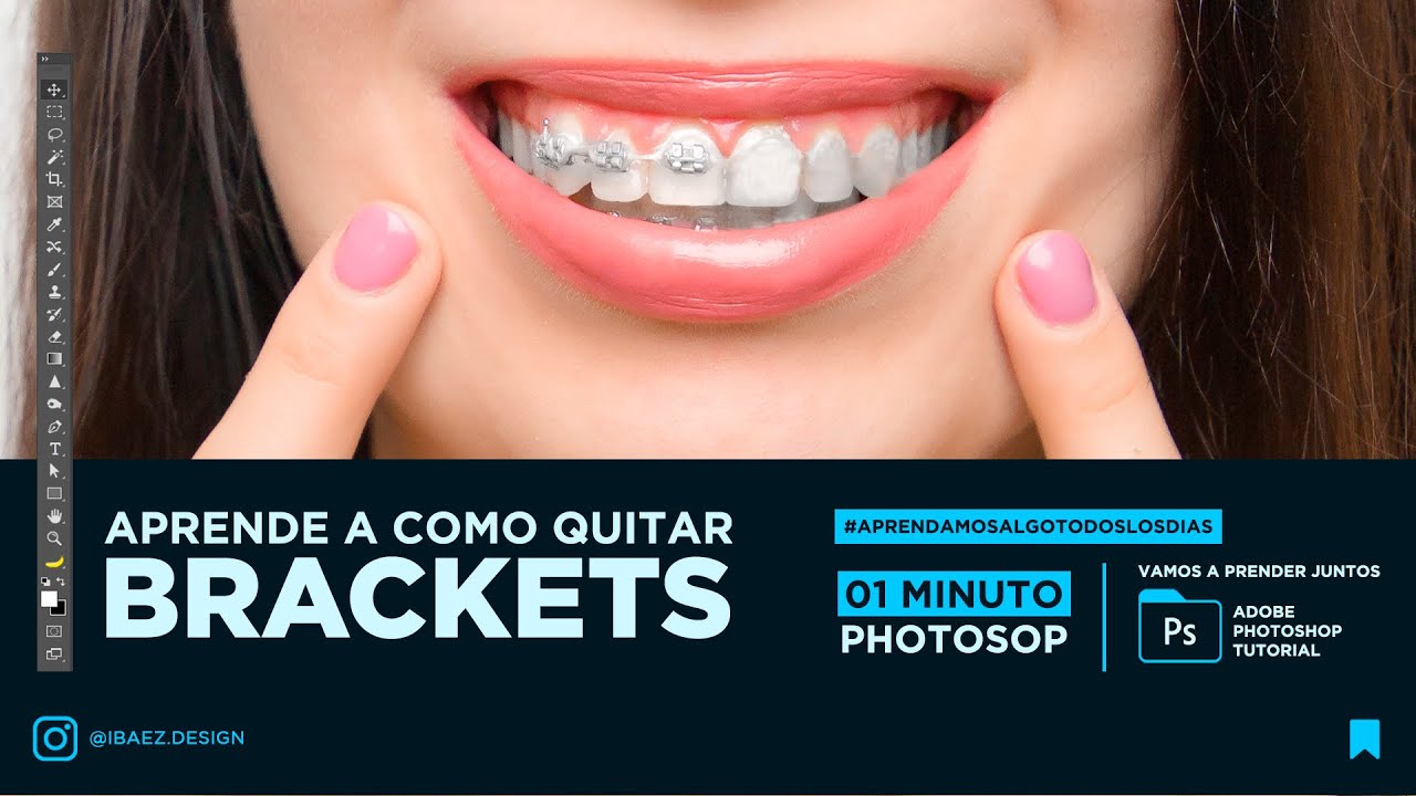 Cuanto cuesta quitarse los brackets en españa