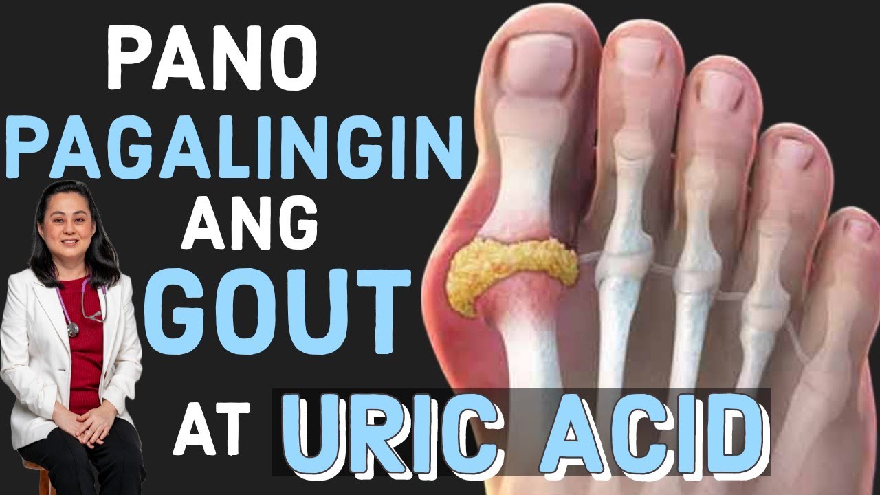 Paano Pagalingin ang Gout at Uric Acid Tips by Doc Liza RamosoOng