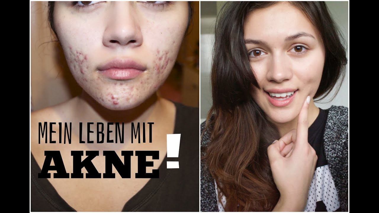 Mein Leben Mit Akne Vorher Nachher Tipps Betterskinwithanna Youtube