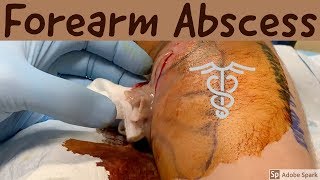 Left arm abscess drainage