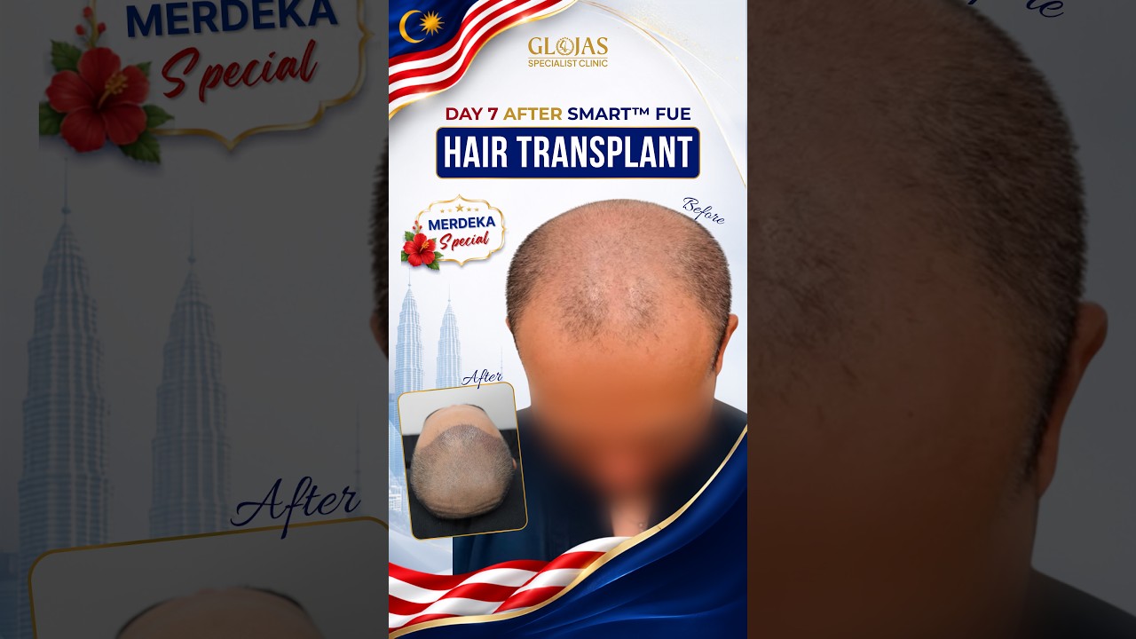 Hair Transplant Malaysia l Day 7 Check-in: Healing Well 🌱 #hairtransplantmalaysia