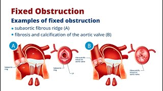 What’s the Difference Between Dynamic and Fixed Obstruction?
