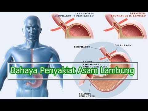  Bahaya Penyakit Asam Lambung YouTube