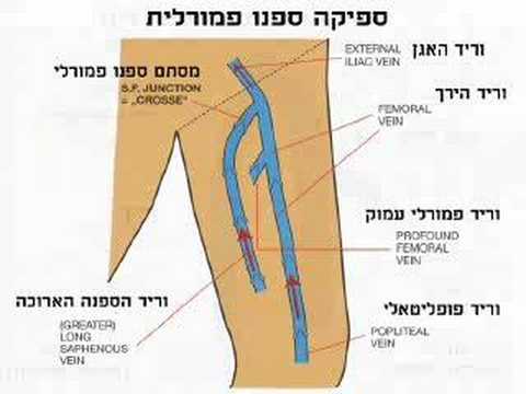 הסיבות להיוצרות ורידים בולטים מורחבים