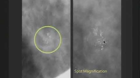 Breast Imaging: Calcifications [Basic Radiology]