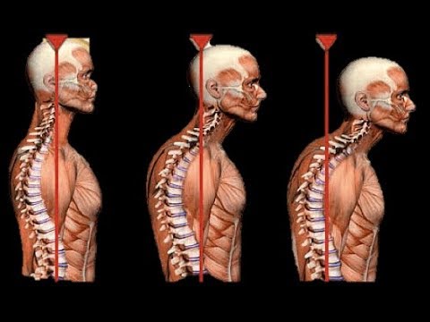 How to truly identify and treat thoracic outlet syndrome (TOS) - MSK  Neurology