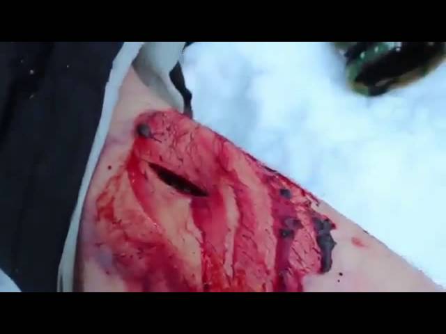 ГЕМАТОМЫ,полевое лечение