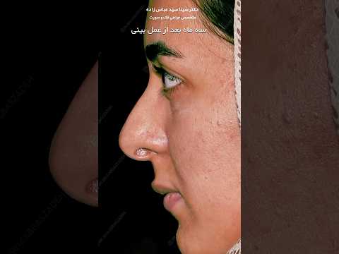 عجیب ترین تغییر عمل بینی جراحی بینی جراحی زیبایی ترند عمل بینی  بینی زیبایی