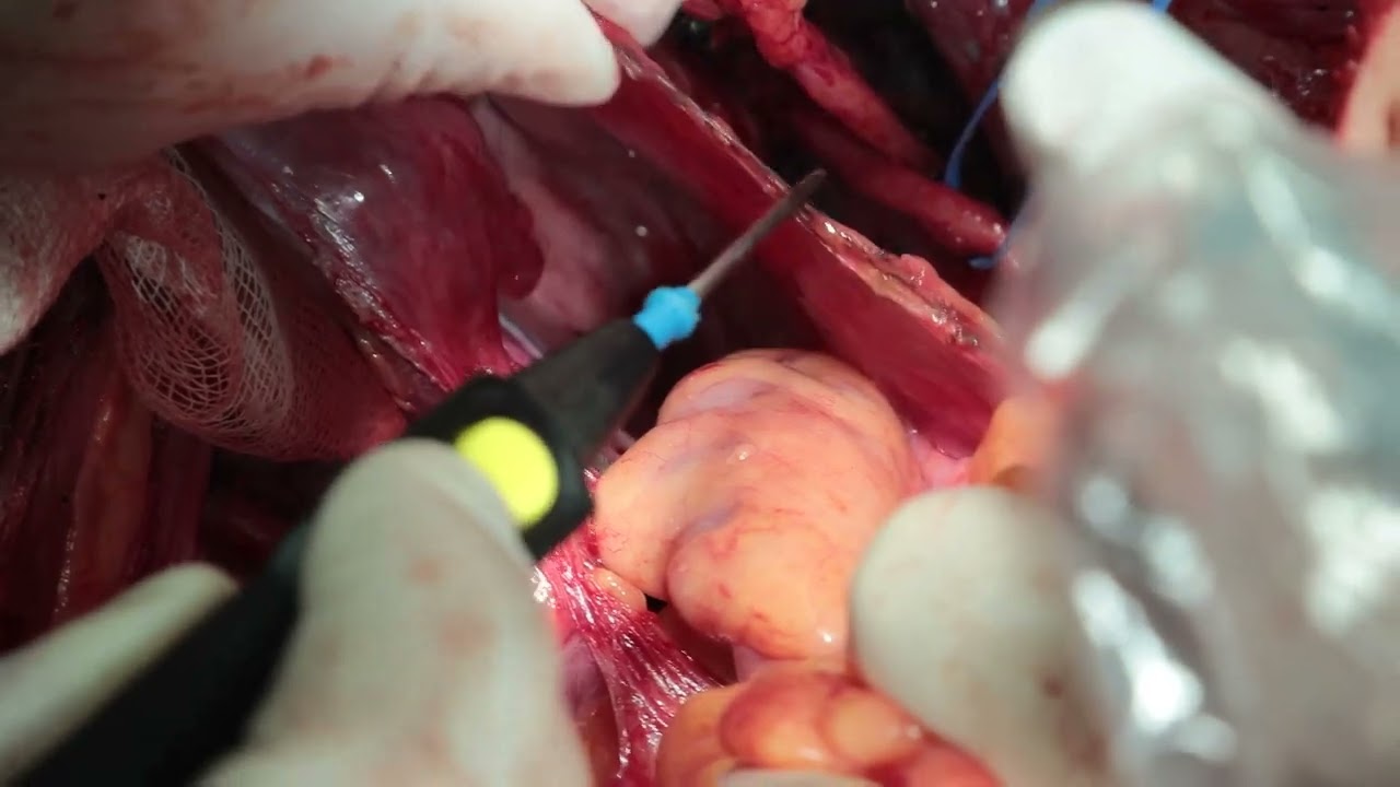 Расширенная гистерэктомия при раке шейки матки лапаротомным доступом (Тип С)