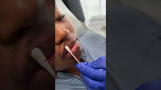 "1ml Juvederm Ultra Lip Filler Before &amp; After | Natural Results"