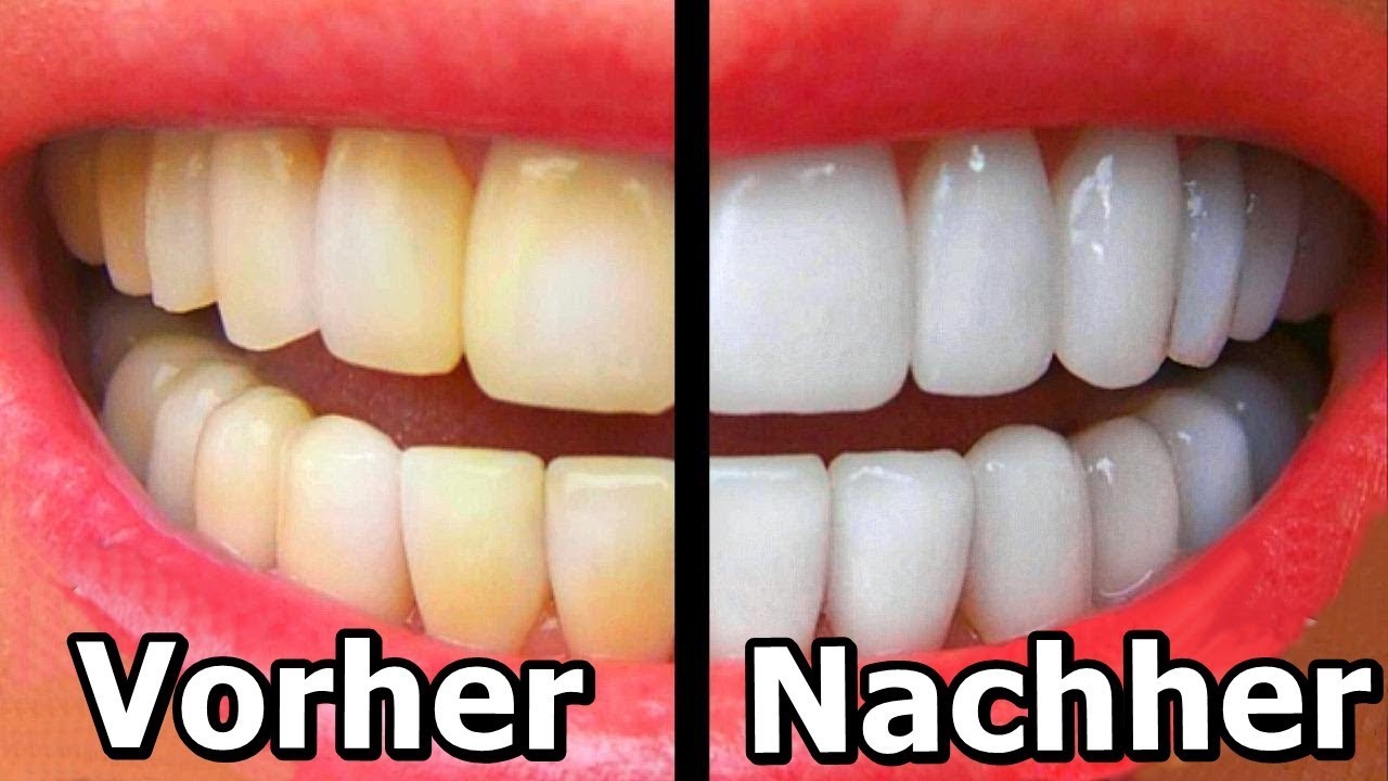 5 Naturliche Hausmittel Die Deine Zahne Aufhellen Youtube