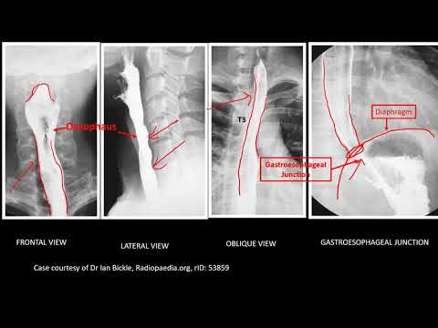 Abdominal X-Ray: Barium swallow, Barium Meal and Barium Enema