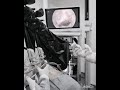Discectomía Endoscopica L5-S1 / Minimal Invasive Spine Surgery