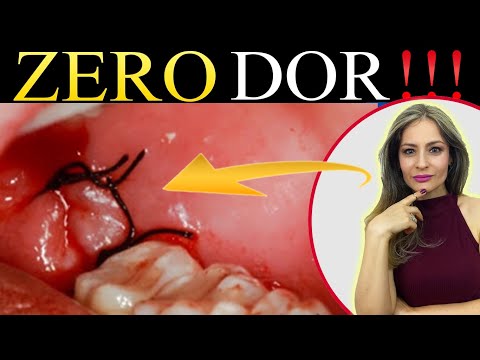 Vídeo: Posso fumar suavemente após a extração do dente?