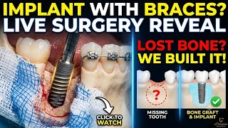 Dental Implant with Bone Grafting Surgery During Braces Treatment | Step-by-Step 