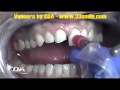 A of prepless dental veneers procedure at cosmetic dental associates san antonio tx