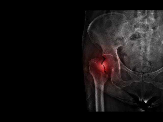 A Closer look at Bone Health and Fracture Risk with Dr. John Neustadt