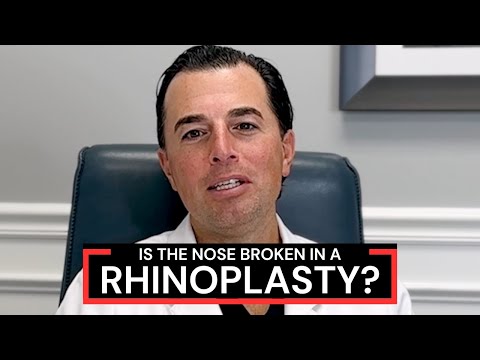 Video thumbnail: What is Osteotomy During Rhinoplasty (Nose Job) Surgery? | Dr. Anthony Corrado · Dr. Anthony Corrado