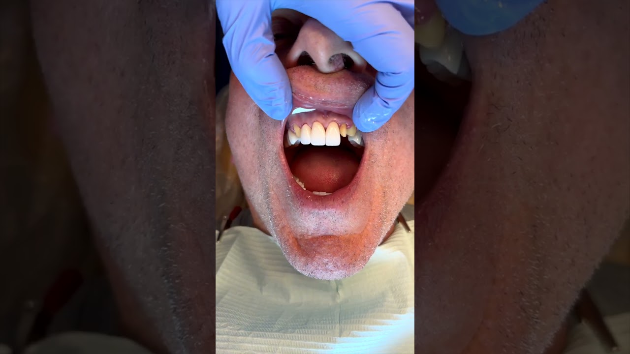 Smile makeover By Dr.Kiumars Rahimi Agoura hills Dental Designs