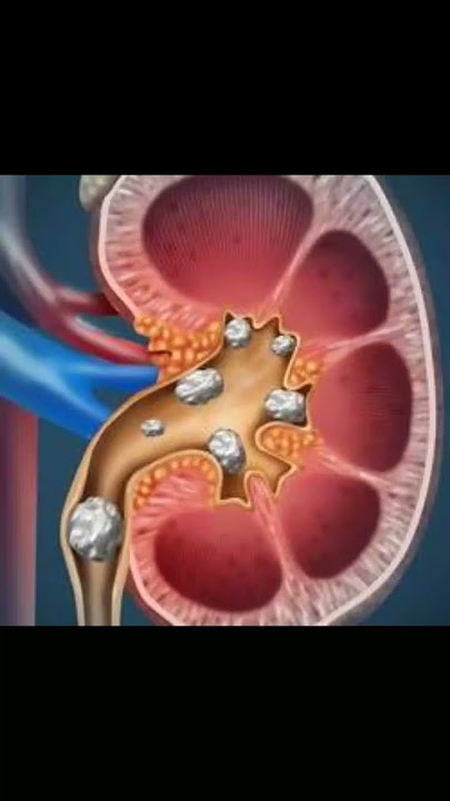 இடுப்பு வலி  @ கிட்னி  பிரச்சனை