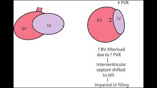 Constrictive Pericarditis vs Restrictive Cardiomyopathy Pathophysiology explained 