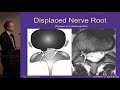 Lumbar MRI:  What the Findings Mean and How They Should Be Reported - J. Jarvik, MD, MPH