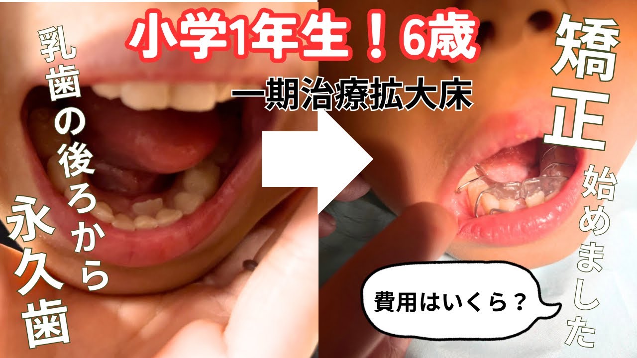 Orthodontics] How Much Does Phase I Treatment Cost for Kids? | Pre