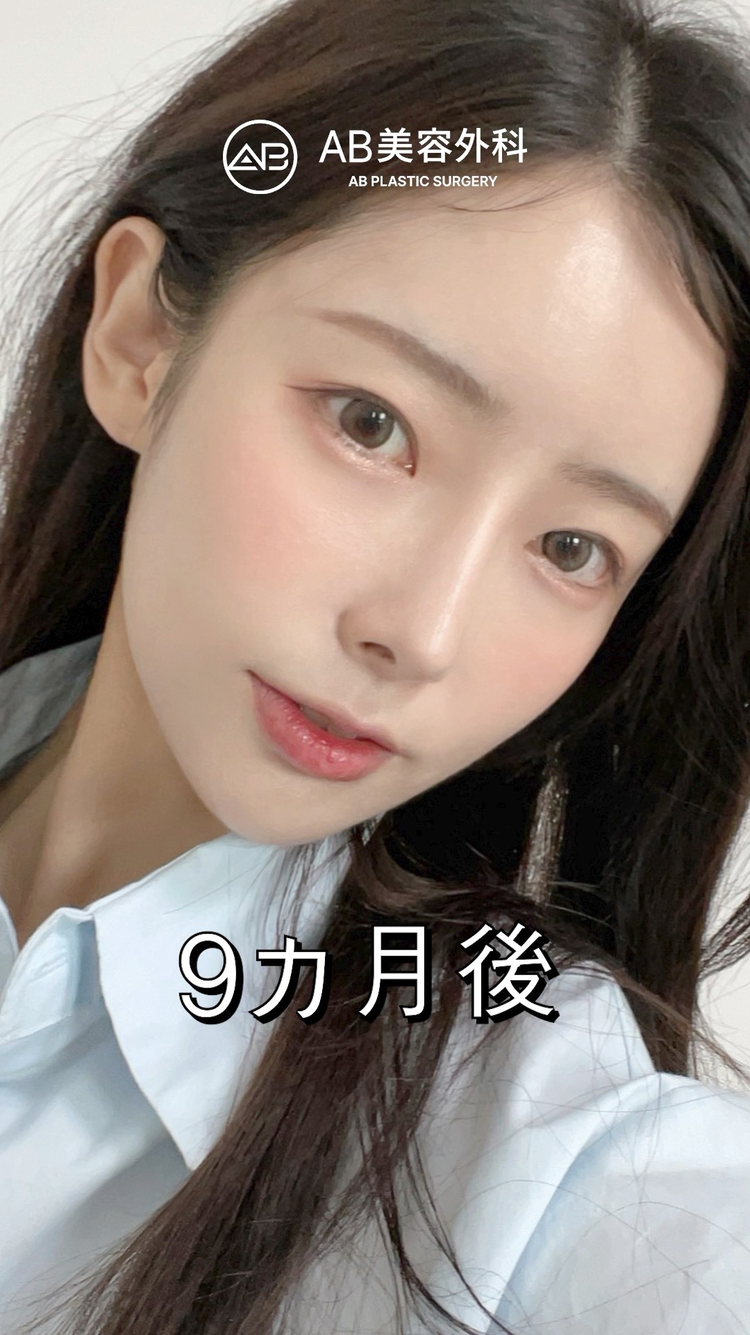 韓国整形で顔面大変身！#shorts