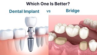 Dental Implant vs Bridge. Which one is better to replace a missing tooth?