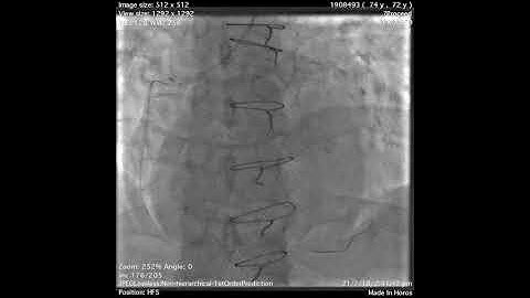 Distal wire perforation in Vein Graft PCI