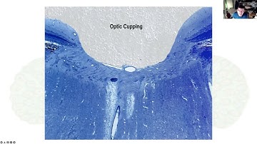 Glaucoma support group: Normal tension glaucoma