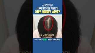 가르마가 휑한 중년 갱년기 여성탈모, 모발이식하세요!
